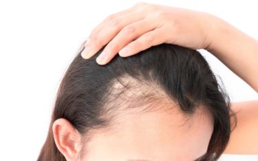 美しい髪を取り戻したい薄毛女性必見！抜け毛の原因と効果的な治療・対策法
